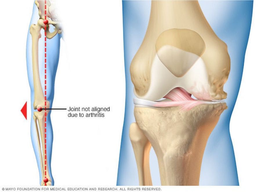 Why Should You Wear A Knee Brace?